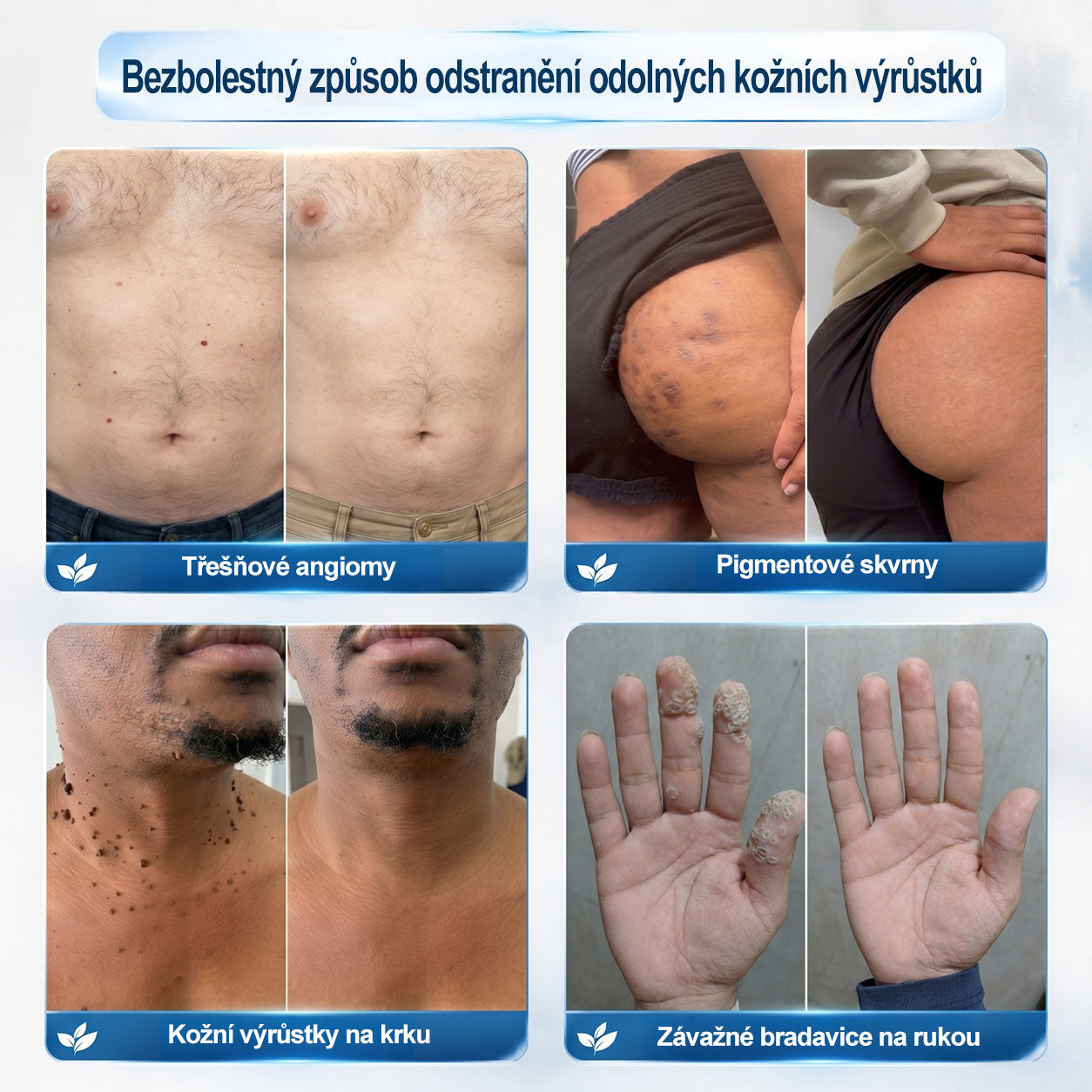 Oficiální značkový obchod | 🎄🎄Hiskin® 7denní odstraňovač skvrn a pigmentových skvrn (Bezbolestný rollerball bez jizev)