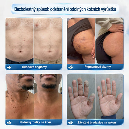 Oficiální značkový obchod | 🎄🎄Hiskin® 7denní odstraňovač skvrn a pigmentových skvrn (Bezbolestný rollerball bez jizev)