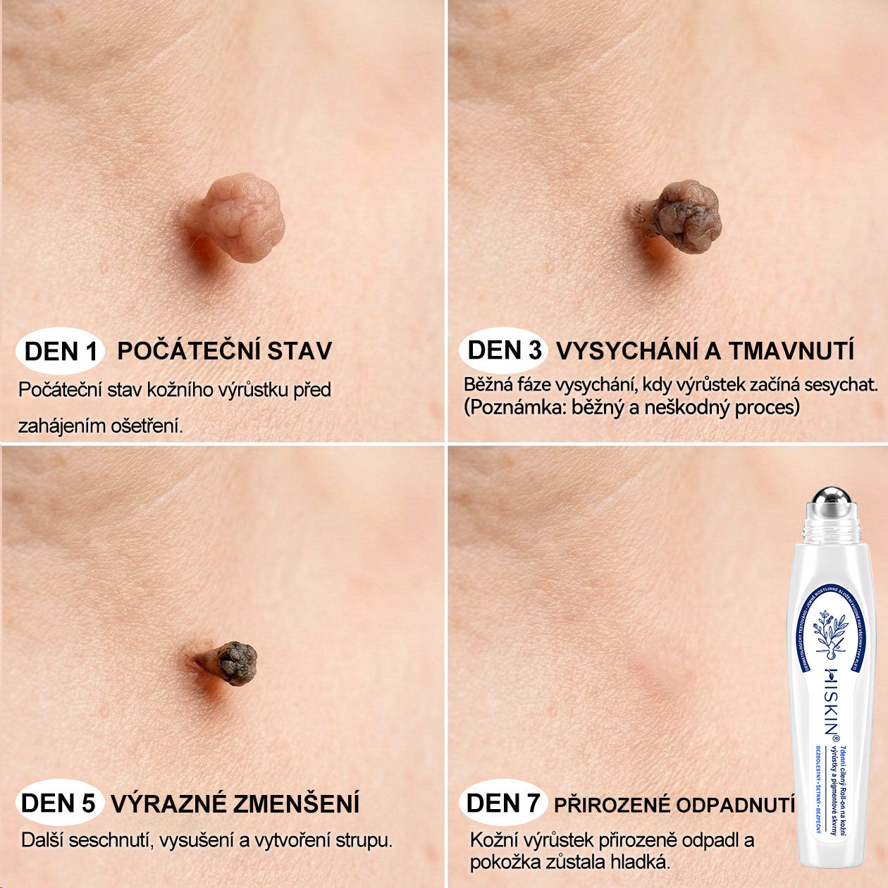 Oficiální značkový obchod | 🎄🎄Hiskin® 7denní odstraňovač skvrn a pigmentových skvrn (Bezbolestný rollerball bez jizev)